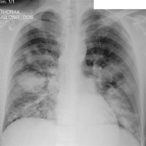 Chest Radiograph On Admission Showing Bilateral Dense Infiltrates