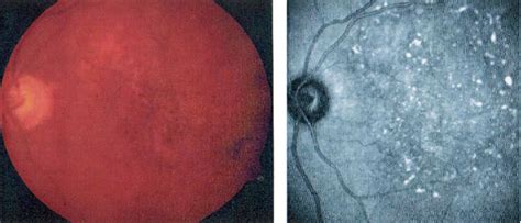 1 Fundus Photography Of The Posterior Pole Atrophic As Well As