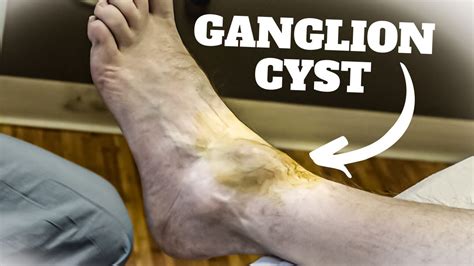 Ganglion Cyst Foot Surgery Recovery Time The Complete Guide