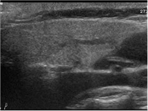 Parotid Gland Lesion Ultrasound