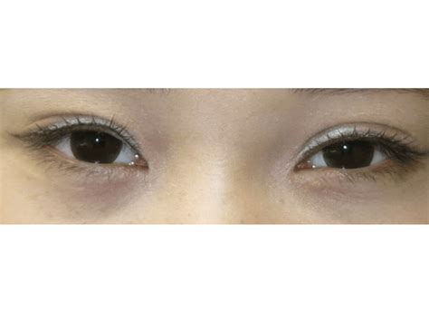 Asian Eyelid Surgery San Francisco L Plastic Surgery By Charles K Lee Md