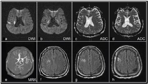 Imaging Findings Of The Patient Axial Diffusion Weighted Imaging Dwi