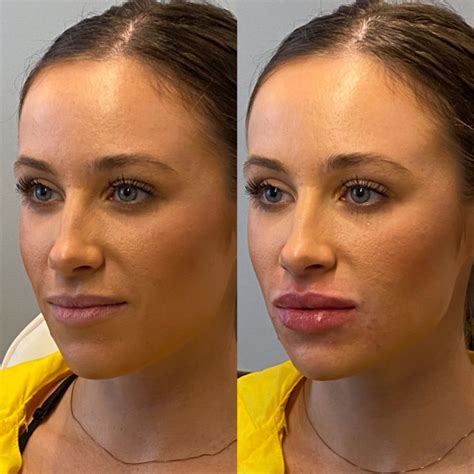 Subtle Lip Filler Before And After