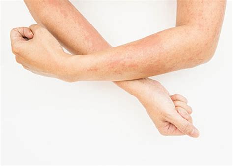 Skin Rash After Virus May Look Alarming But Its Not Uncommon