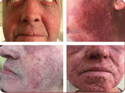 Skin Rash Consisting Of Erythematous Violaceous Papules And Pustules
