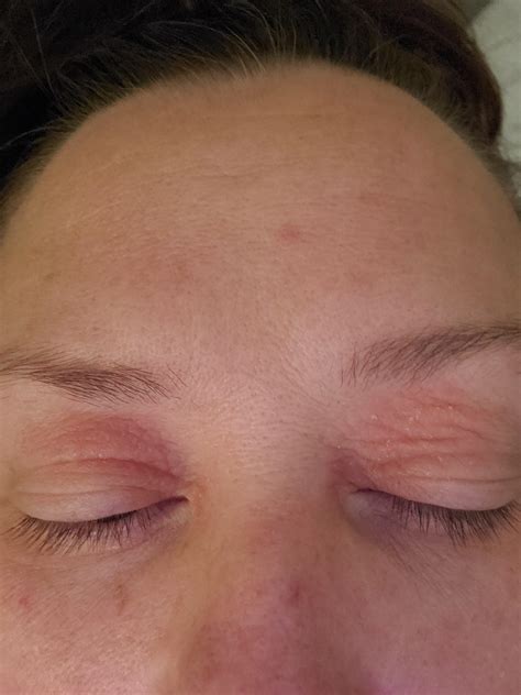 Has Anyone Experienced Eyelid Issues Any Ideas For Treatment R Lupus