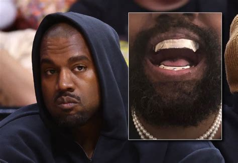 Kanye West Rep Confirms He Has Permanent Titanium Teeth
