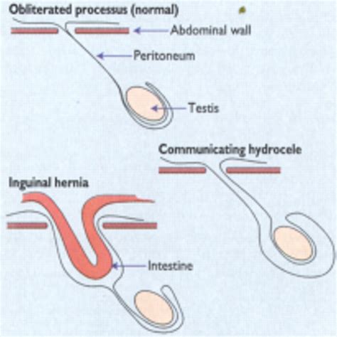 Abc Of General Paediatric Surgery Inguinal Hernia Hydrocele And The