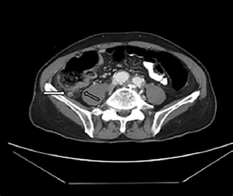 Ct Scan Of The Abdomen Showing Revealed Extensive Atherosclerotic