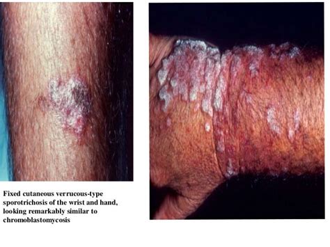 Sub Cutaneous Fungal Infections