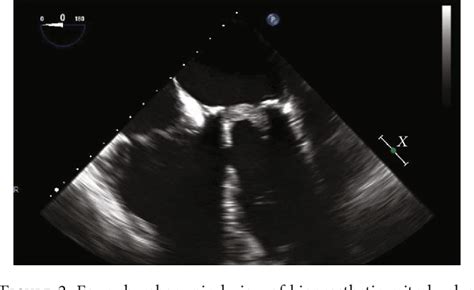 Figure 1 From A Case Of Acute Massive Bioprosthetic Mitral Valve