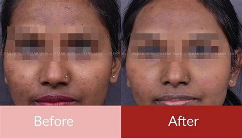 Skin Pigmentation Treatment Before And After Images