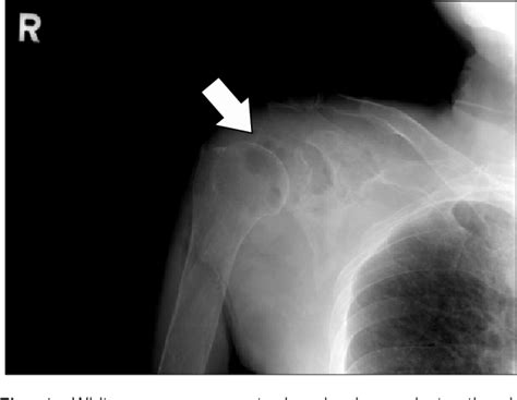 Cancer might be a big part of your life, but it doesn't define who you are. Figure 1 from Right Shoulder Pain due to Metastatic Lung ...