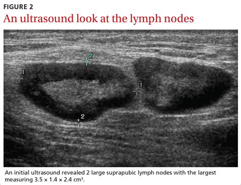 Groin Lymph Node Swelling