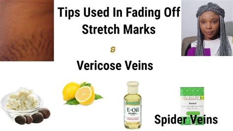 Tips Used In Fading Off Stretch Marks And Vericose Veins Spider Veins