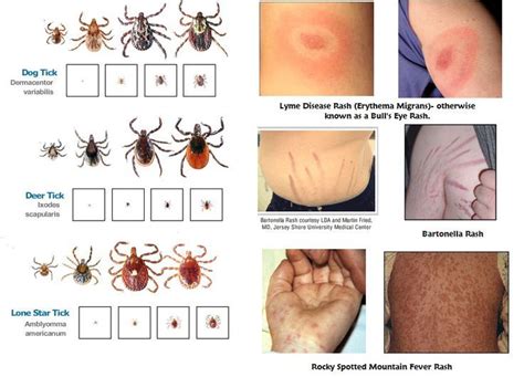 Lyme Disease Tick Rash Ticks