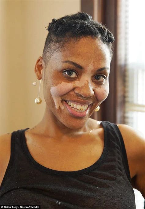 Meet Black Woman With Vitiligo Says Men Adore Her White Patches