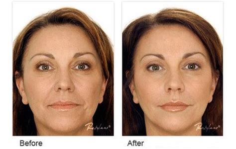 Restylane Dermal Fillers The Dynamic Duo Of Facial Rejuvenation