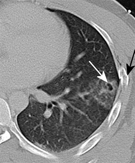 Lung Laceration Type Iv Axial Ct Image Of The Left Lung At Lung
