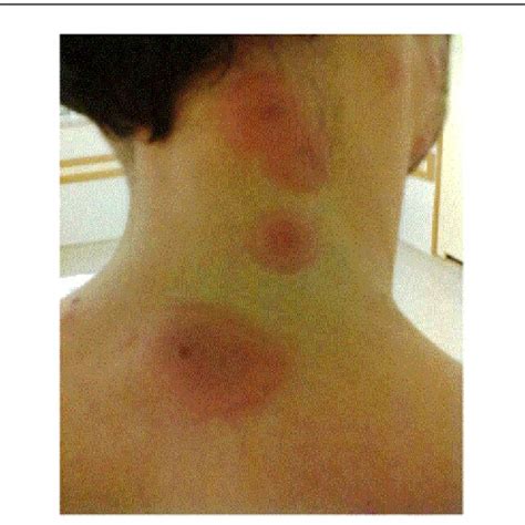 Multiple Well Circunscribed Erythematous To Violaceous Papules And