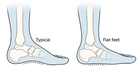 Pigeon Tip Toe Flat Feet Pronation Children Medical Problems