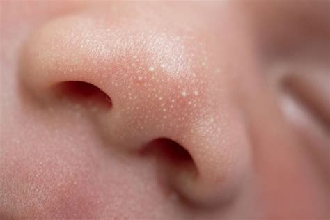 White Spots On A Childs Face Causes Remedies And Treatment