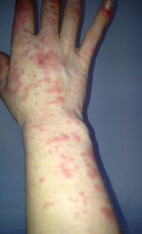Lupus Skin Lesions From Sun