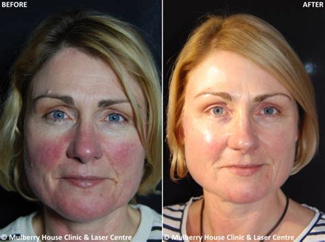Rosacea Treatment Review And Results Mulberry House Clinic