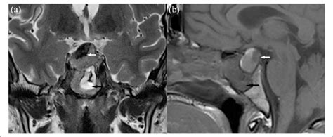 A T2 Weighted Coronal View Mri Sequence From The Posterior Part Of