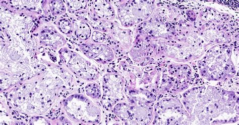 Pathology Outlines Lactating Adenoma