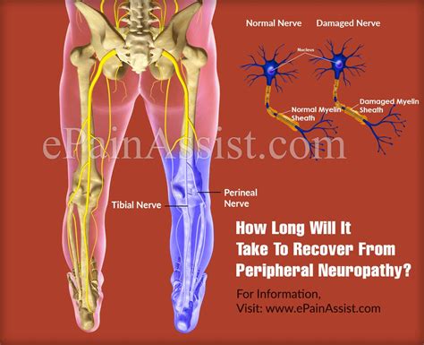 How Long Will It Take To Recover From Peripheral Neuropathy And How Long