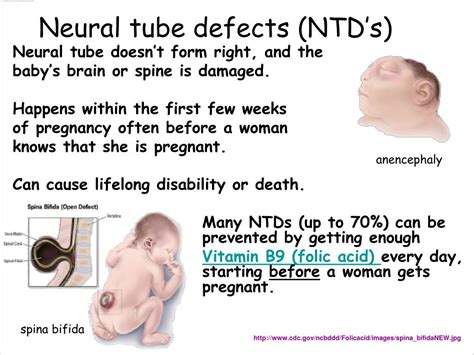 PPT Neural Tube Defects NTDs PowerPoint Presentation Free Download ID