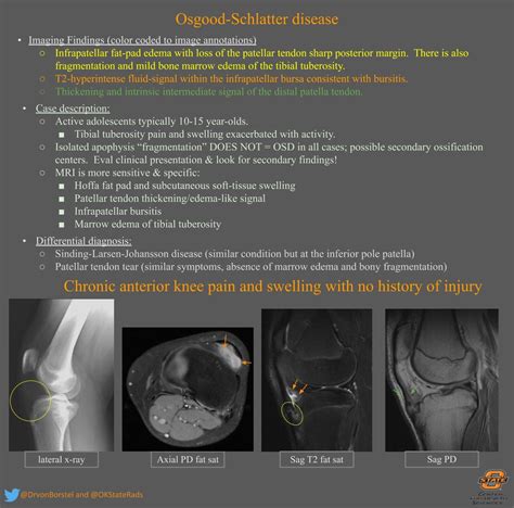 Osgood Schlatter Disease Msk Radiology Imaging Findings Grepmed