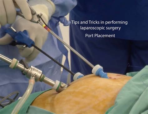 Tips And Tricks In Laparoscopic Surgery Port Placement Melaka Fertility