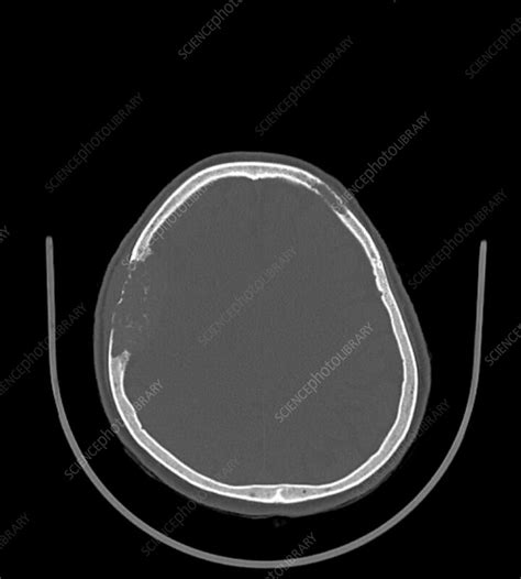 Bone Metastasis Ct Scan Stock Image F0393306 Science Photo Library