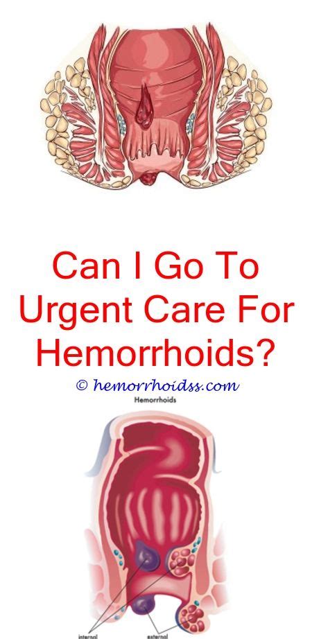 Does Hemorrhoid Cream Help How Serious Is Stage 4 Hemorrhoidshow To