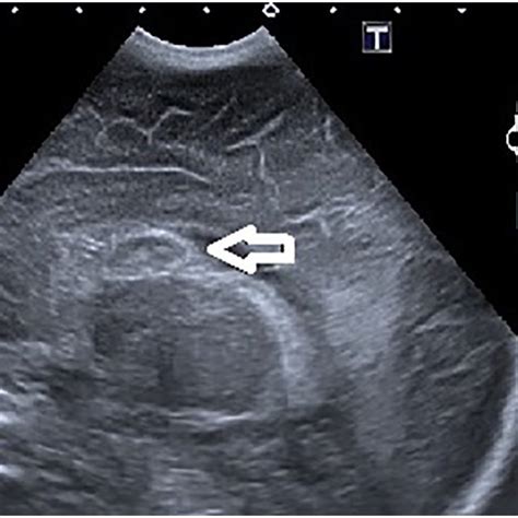 Intraventricular Hemorrhage In Case 57 The Arrow Marks The Place Of