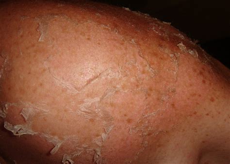 Scaly Skin Dorothee Padraig South West Skin Health Care