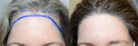 Forehead Reduction Surgery Miami Hairline Lowering Surgery