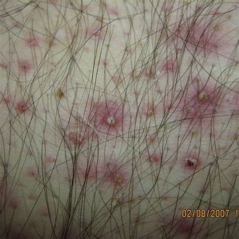 Folliculitis And Boils Dermboard