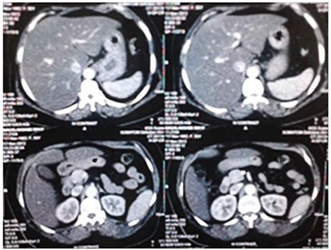 Enlarged Liver Ct Scan
