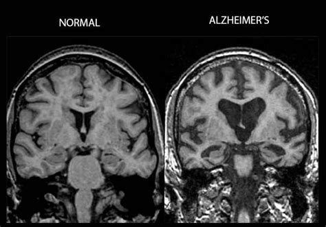 We Need To Talk About Alzheimers Disease