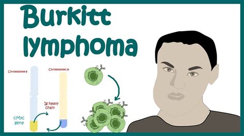 Burkitts Lymphoma Aggressive B Cell Non Hodgkins Lymphoma