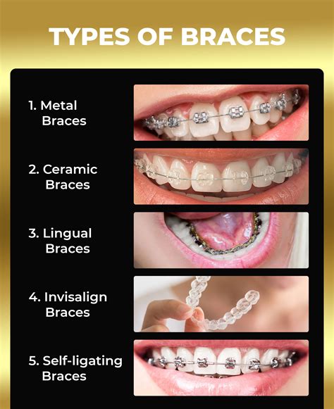Types Of Braces Discover The Best Braces For Your Smile