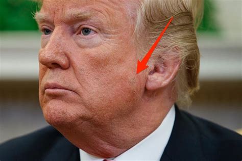 what is that spot on donald trump s face probably keratosis