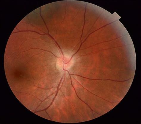 Fundus Examination Of The Right Eye Showed A Swollen Optic Disc