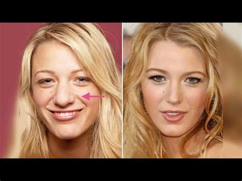Blake Lively Before Nose Job Nose Surgery Celebrity Plastic Aniston