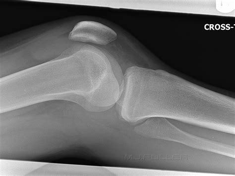 Knee Trauma E Wikiradiography