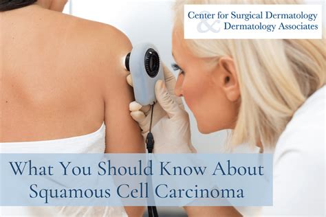 What You Should Know About Squamous Cell Carcinoma Scc