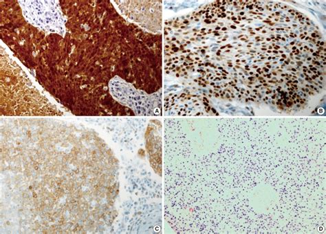 Representative Photomicrographs Of An Tonsillar Squamous Cell Carcinoma Download Scientific